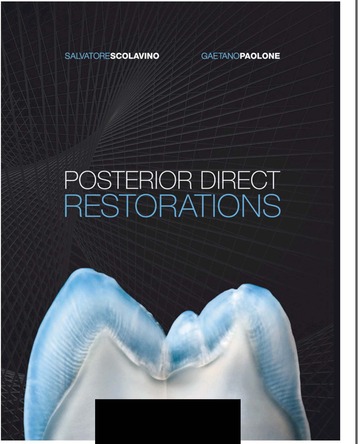 Posterior Direct Restorations