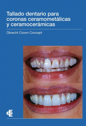 Tallado dentario para coronas ceramometlicas y ceramocermicas