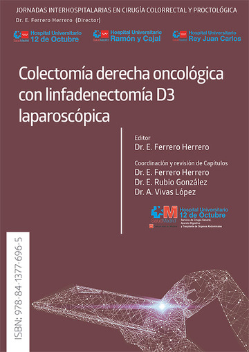 Colectoma derecha oncolgica con linfadenectoma D3 laparoscpica