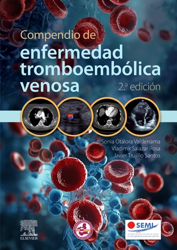 Compendio de enfermedad tromboemblica venosa