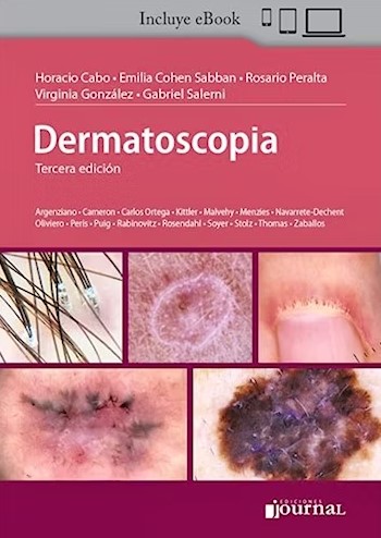 Dermatoscopia